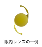 眼内レンズ