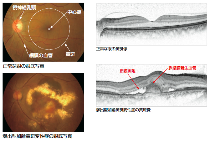 黄斑変性症眼底写真等によるによる比較