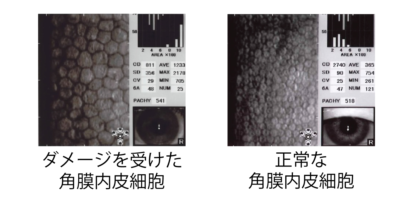 角膜内皮細胞の比較