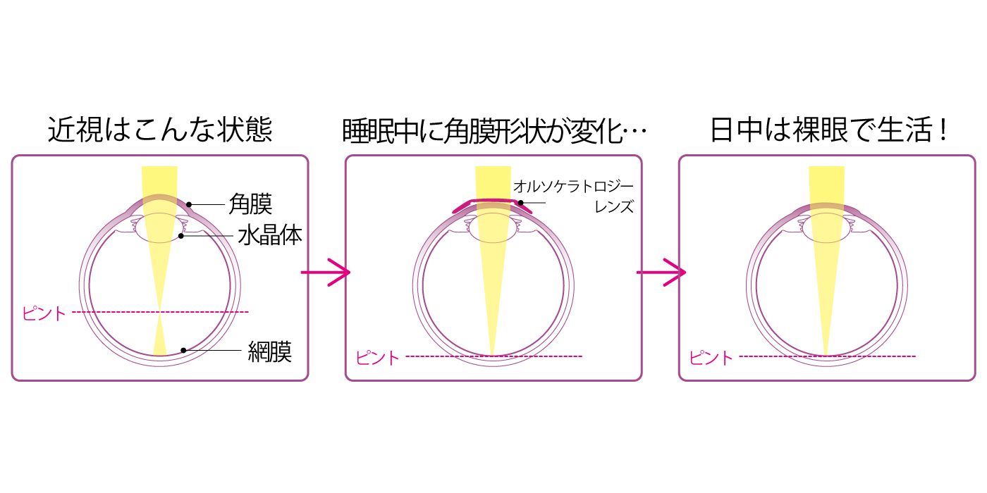 オルソケラトロジーとは？