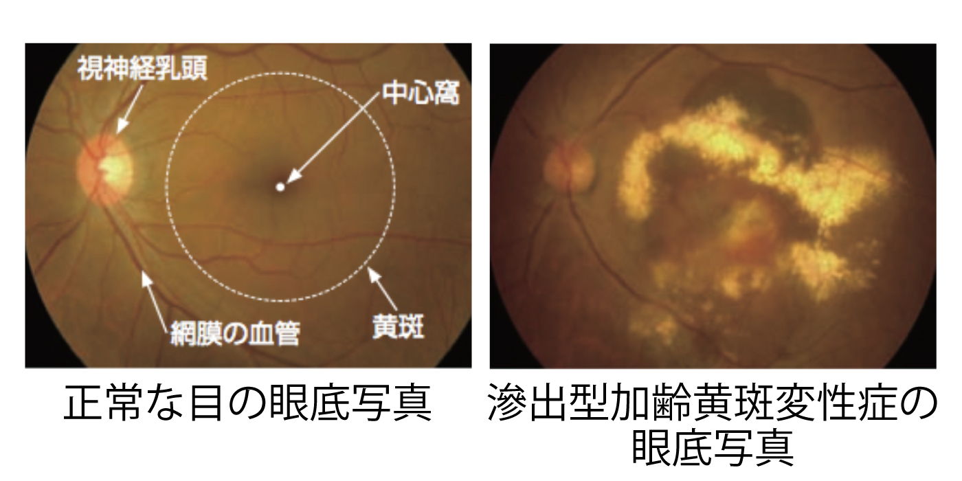 黄斑変性症眼底写真によるによる比較