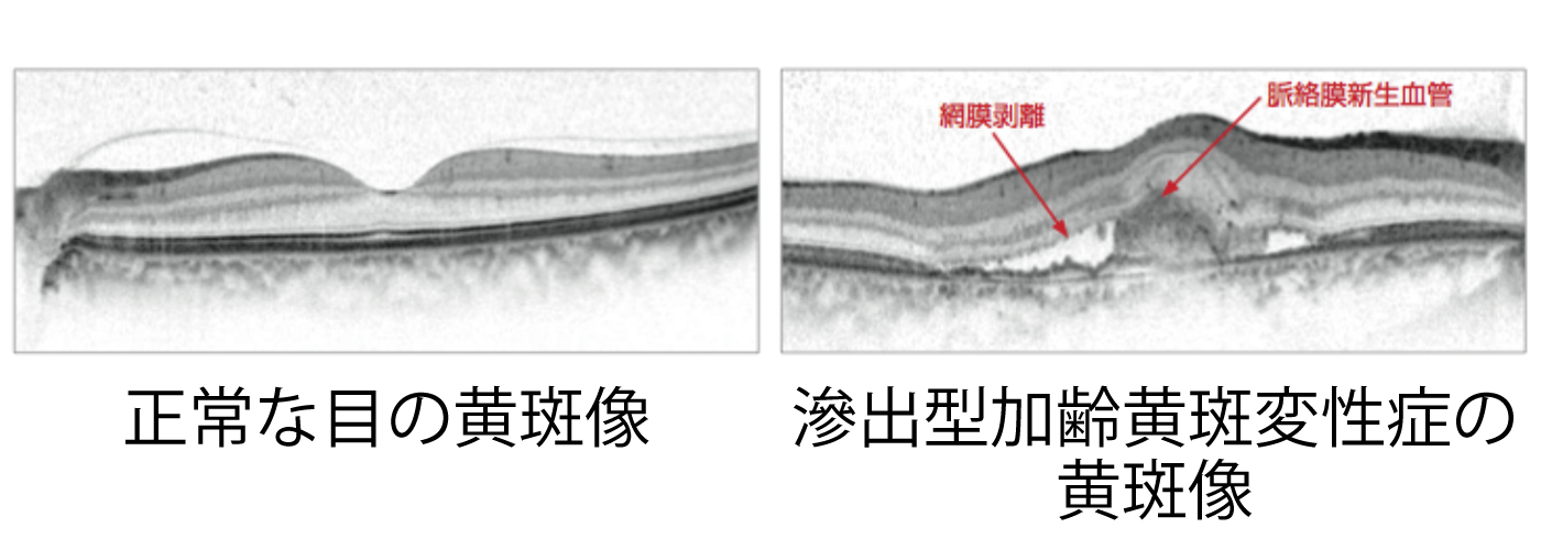 黄斑像によるによる比較