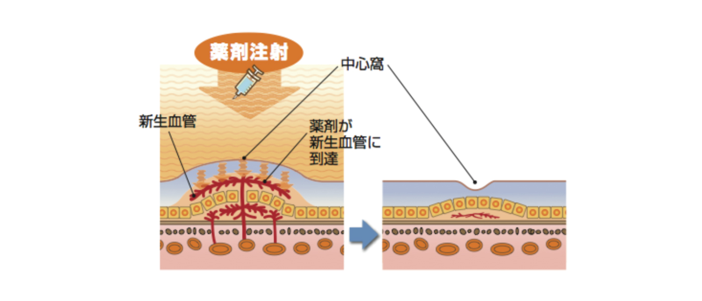 抗VEGF薬治療イメージ