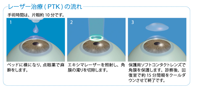 レーザー治療（PTK）の流れ