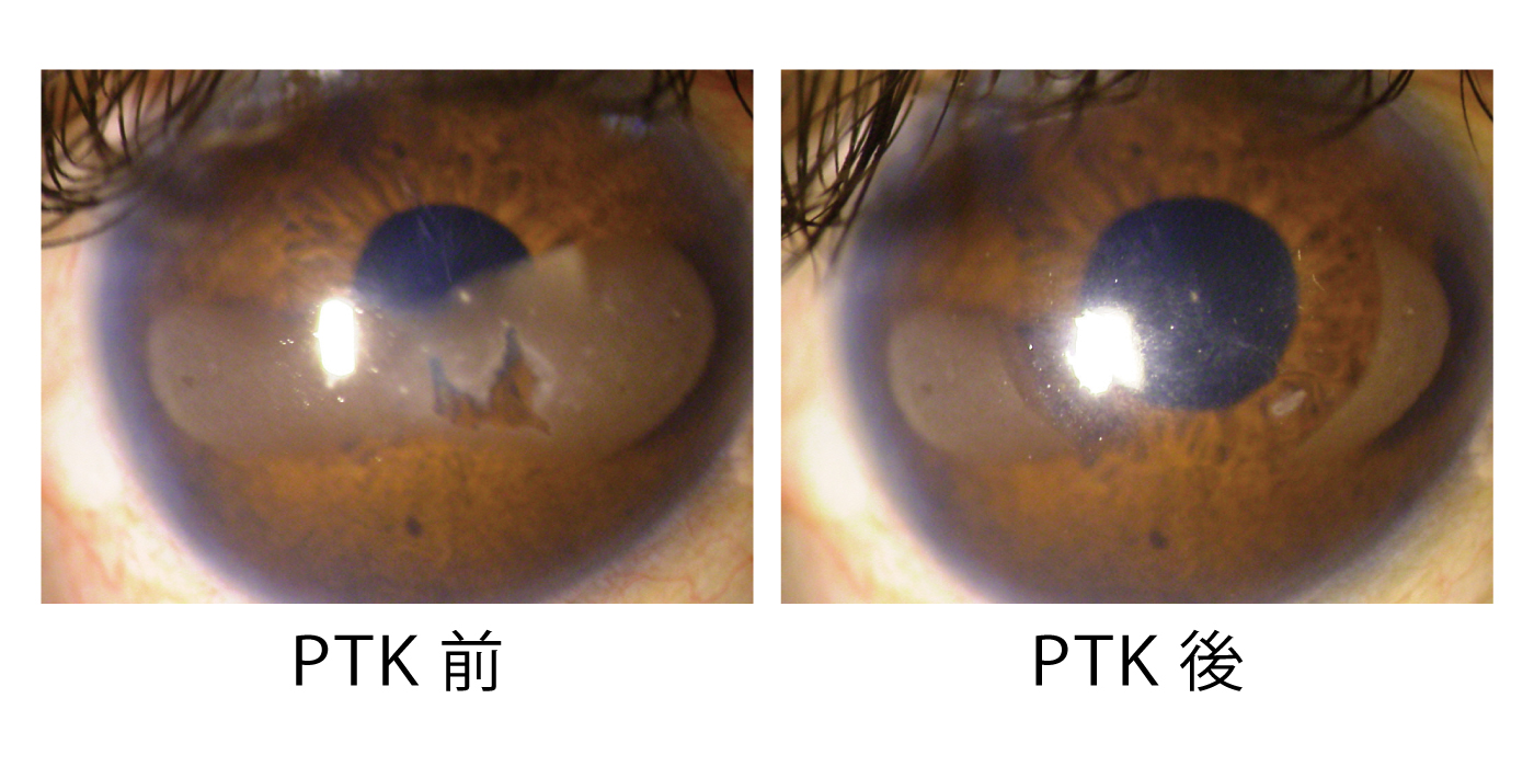 帯状角膜変性に対するPTK前後