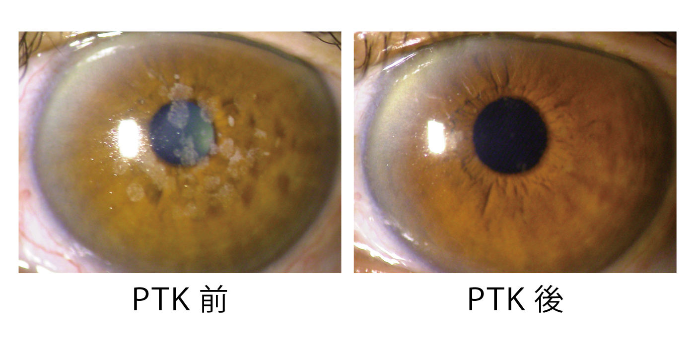 アベリノ角膜変性に対するPTK前後